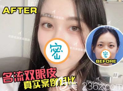 沈阳名流双眼皮开眼角真人术前术后对比效果照片 沈阳名流双眼皮开眼角真人术前术后对比效果照片