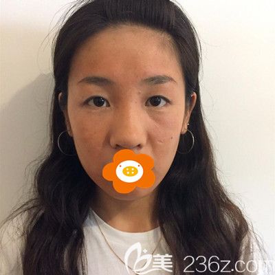 做双眼皮隆鼻手术前的我 做双眼皮隆鼻手术前的我