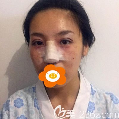 刚做完手术拍的照片 刚做完手术拍的照片