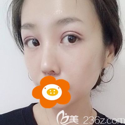 术后20天眼睛还有点肿 术后20天眼睛还有点肿