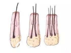 毛囊中的头发数量在1-4根左右 毛囊中的头发数量在1-4根左右