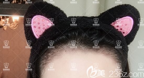 发际线线种植一周效果图