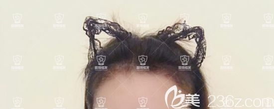 植发际线一个月了，长出了小绒毛