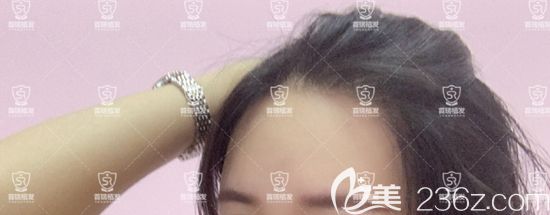 95后小姐姐来分享圆弧形发际线种植经历，为了变美！所以“植”得