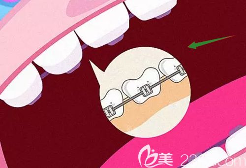 周瑾帆医生解答什么是舌侧矫正