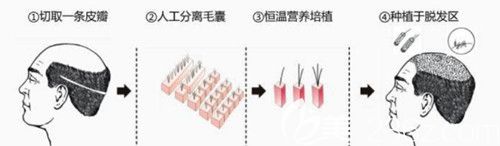 胡志浩医生采用FUE植发技术 胡志浩医生采用FUE植发技术