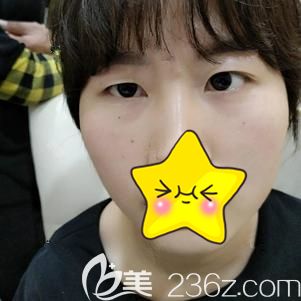 天生的大小眼真的非常难看 天生的大小眼真的非常难看