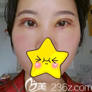 做完眼综合手术后即刻肿胀明显 做完眼综合手术后即刻肿胀明显