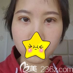 术后7天到院拆线轻微红肿 术后7天到院拆线轻微红肿