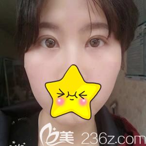 眼部整形术后25天肿胀已逐渐消除 眼部整形术后25天肿胀已逐渐消除