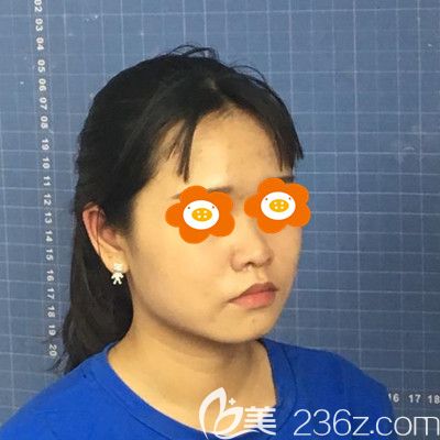 做埋线提升手术前的我 做埋线提升手术前的我