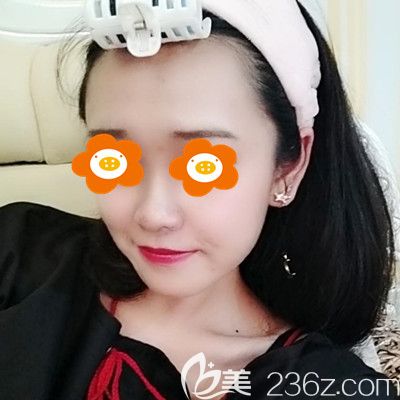 面部埋线提升术后28天效果 面部埋线提升术后28天效果