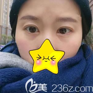 都以为我花了一万多做眼综合才改善了大小眼，其实只花了不到一半的价钱