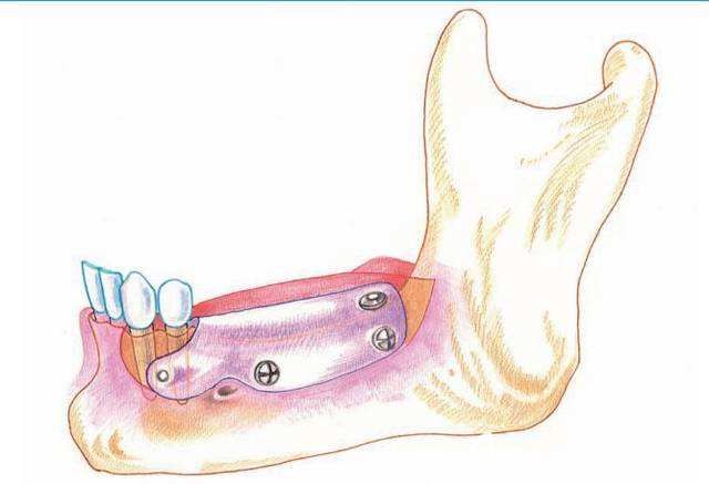 骨增量技术 骨增量技术