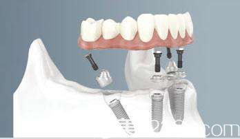 全口/半口种植牙 全口/半口种植牙