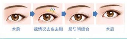 高主任做眼部整形的手术步骤示意图