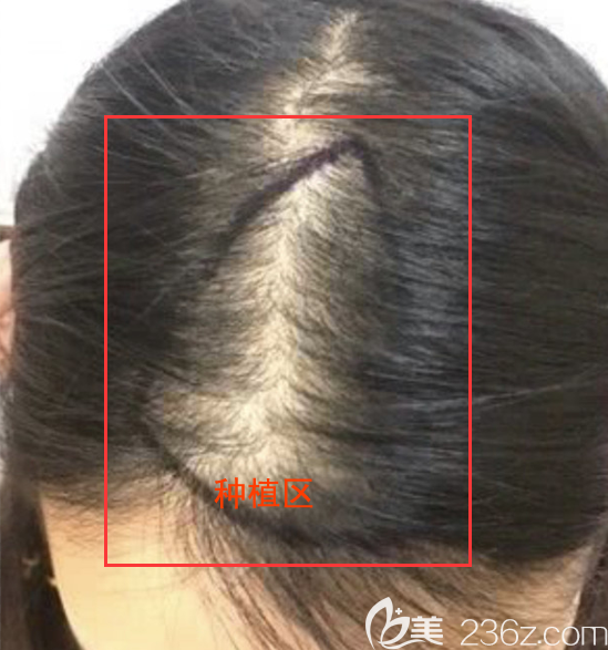 医生给我规划的种植区域 医生给我规划的种植区域