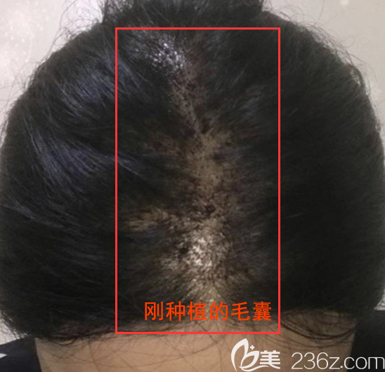 头顶加密种植术后即刻照片 头顶加密种植术后即刻照片