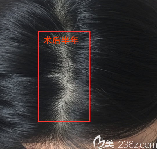 作为一个女性雄激素脱发患者,我选择了头顶加密种植挽回形象