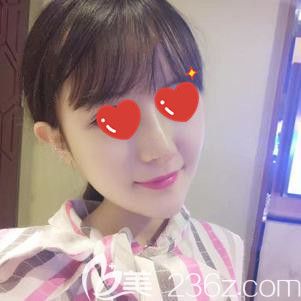 自体脂肪填充面部术后5天脸型改善明显 自体脂肪填充面部术后5天脸型改善明显