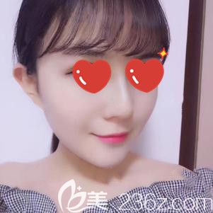 面部填充术后20天肿胀针眼消除 面部填充术后20天肿胀针眼消除