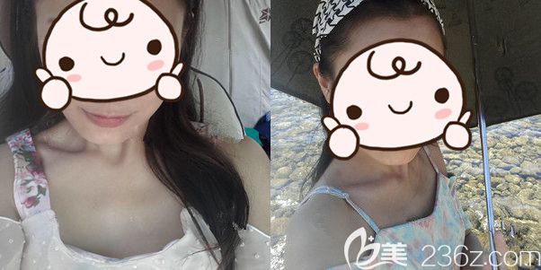 术前胸部较平罩杯较小 术前胸部较平罩杯较小