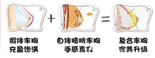 假体植入+脂肪填充的复合丰胸效果 假体植入+脂肪填充的复合丰胸效果