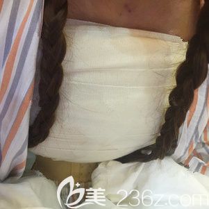 刚做完复合隆胸术后胸部胀痛 刚做完复合隆胸术后胸部胀痛