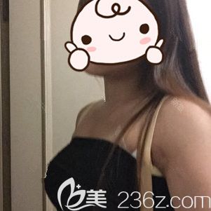 术后8天复合式隆胸的恢复效果 术后8天复合式隆胸的恢复效果