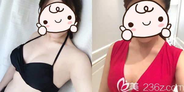 想要假体隆胸罩杯增大+脂肪填充的手感，复合隆胸满足了我的贪心