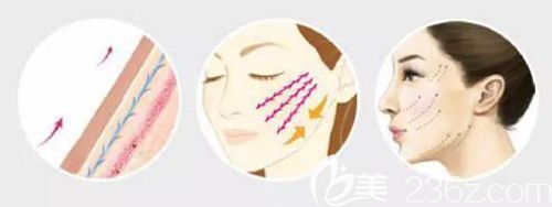 韩医生做埋线提升除皱的原理图 韩医生做埋线提升除皱的原理图