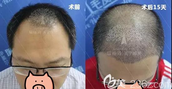 植发半个月前后效果对比图