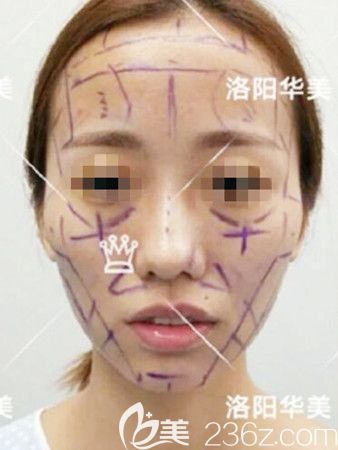 脂肪填充术前 脂肪填充术前