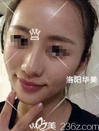 脂肪填充5天恢复效果 脂肪填充5天恢复效果