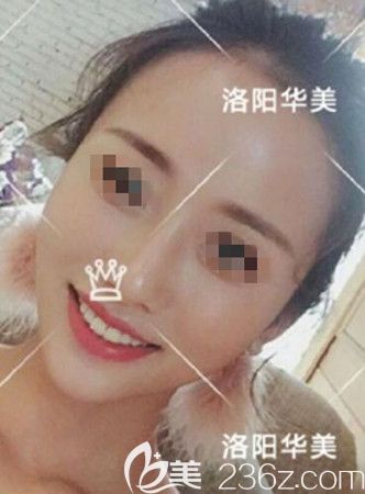 脂肪填充一个月恢复效果 脂肪填充一个月恢复效果