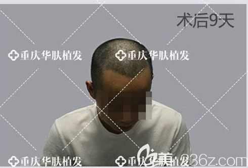 植发后第9天,头上长出了发茬 植发后第9天,头上长出了发茬