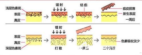 孙医生采用激光祛斑手术简易图 孙医生采用激光祛斑手术简易图
