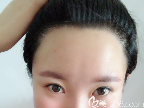 ​额头两边发际线高让我的脸大了1倍!这个问题在发际线种植1800毛囊单位后终于解决了