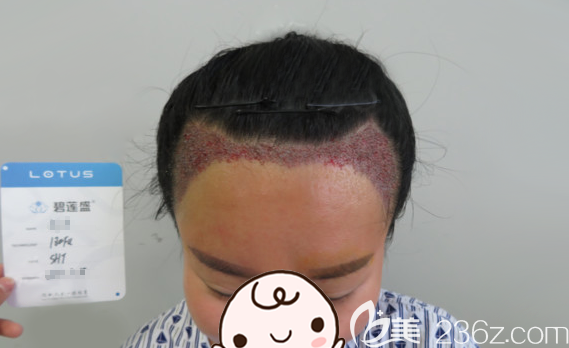 刚做完发际线种植,额头看着小多了 刚做完发际线种植,额头看着小多了