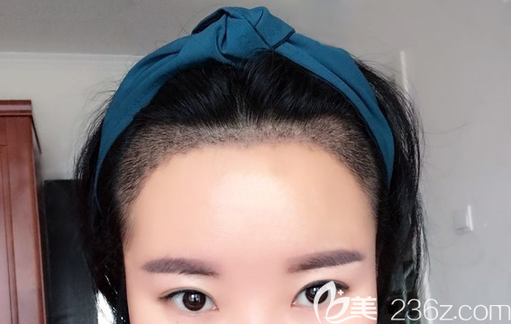 植发术后15天的恢复情况 植发术后15天的恢复情况