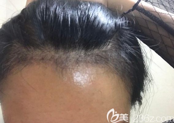 发际线种植3个月脱落期时候的照片 发际线种植3个月脱落期时候的照片
