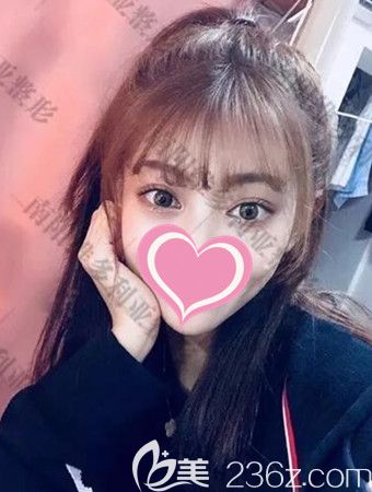 双眼皮手术后30天的恢复照片