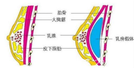 隆胸假体置入位置示意图