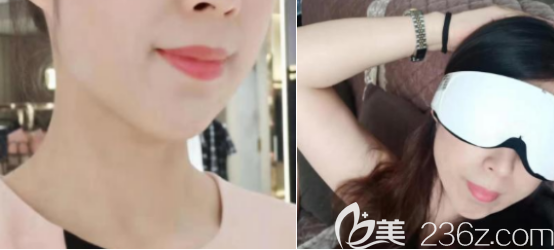 我用五年的时间来向大家证明假体垫下巴会发生磨骨和移位现象是谣言