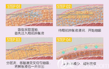 李启飞做水动力吸脂手术过程