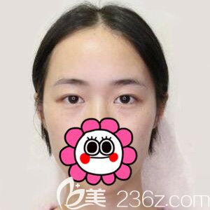 做定点双眼皮开眼角术前照 做定点双眼皮开眼角术前照