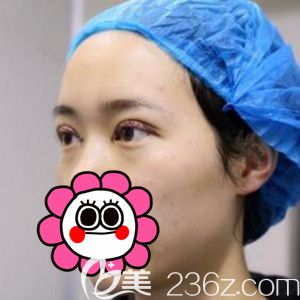 做完定点双眼皮术后即刻<span style= 做完定点双眼皮术后即刻<span style=