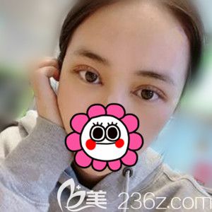 做定点双眼皮术后7天恢复<span style= 做定点双眼皮术后7天恢复<span style=