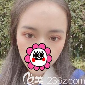 做定点双眼皮开眼角术后半个月恢复<span style= 做定点双眼皮开眼角术后半个月恢复<span style=