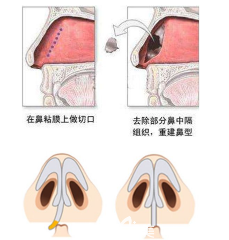 鼻中隔黏膜下矫正手术